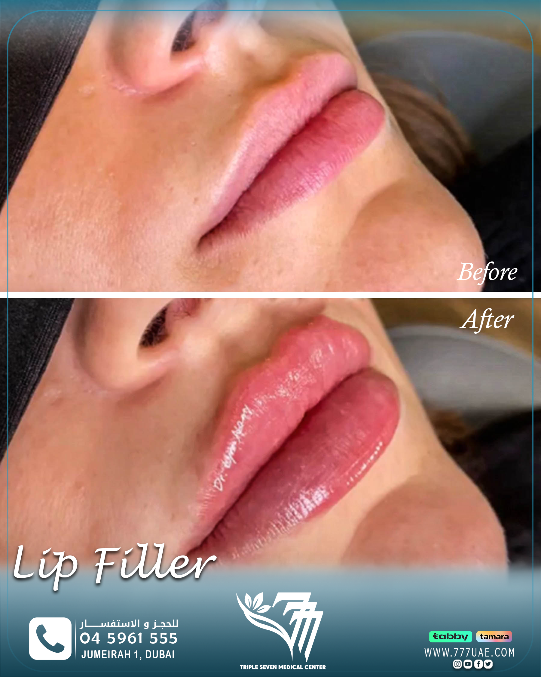 Lip filler B&A