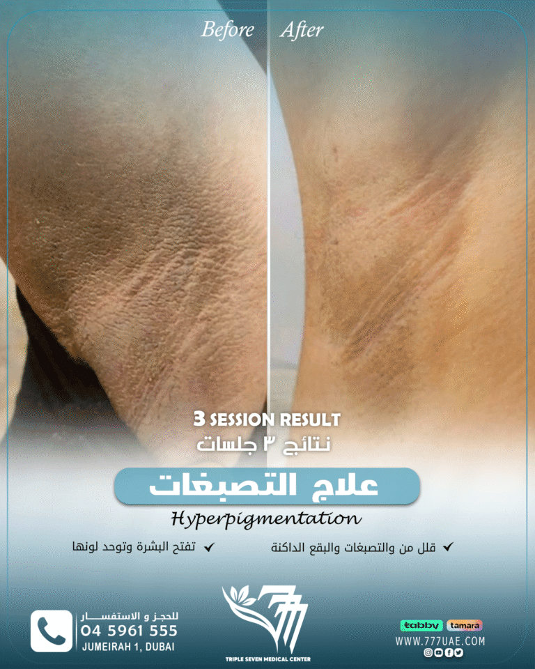 Hyperpigmentation B&A 1