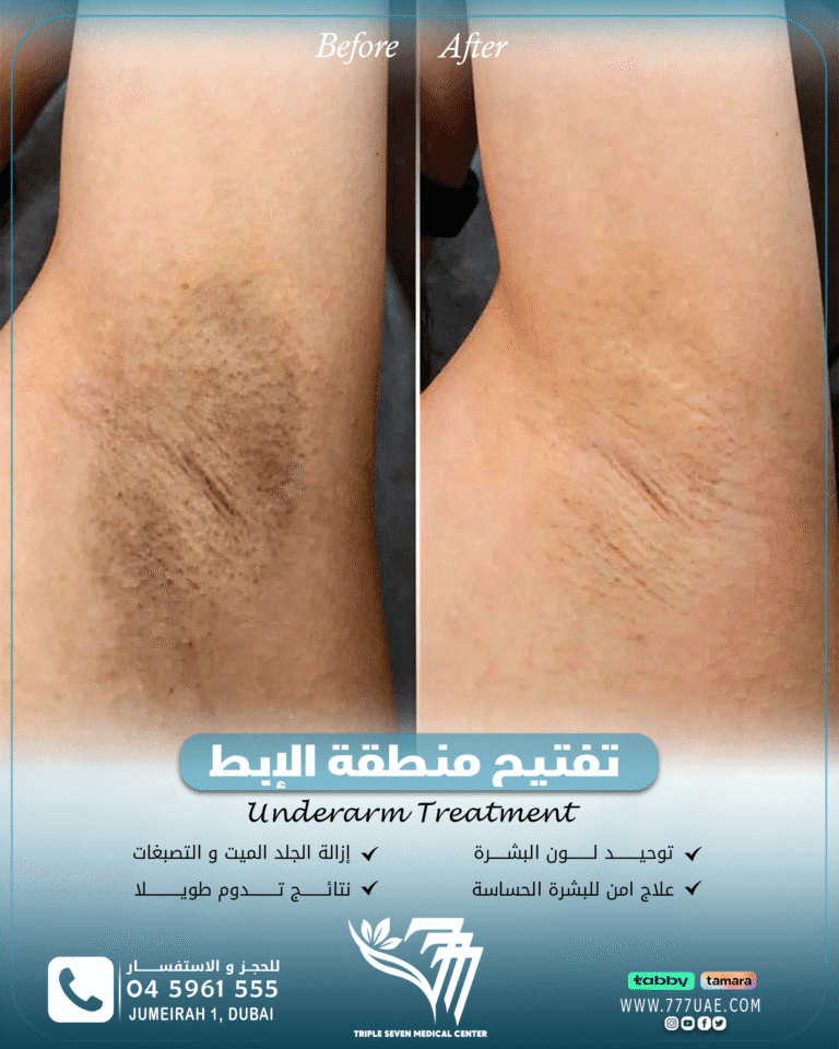 Lip filler B&A copy (1)