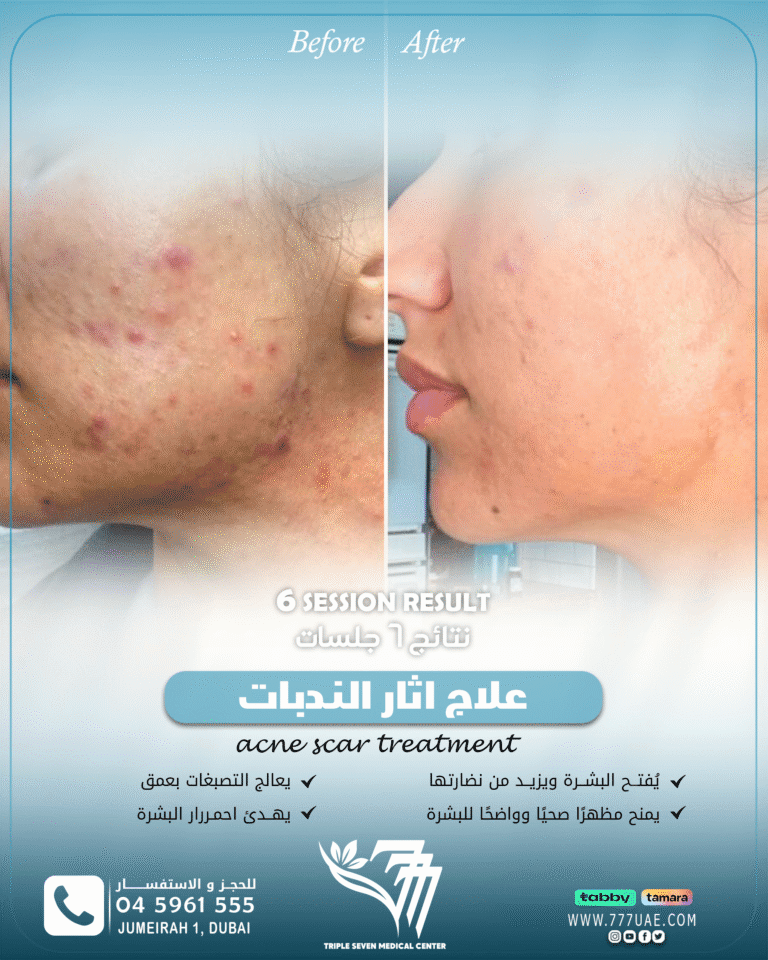 acne scar B&A 2